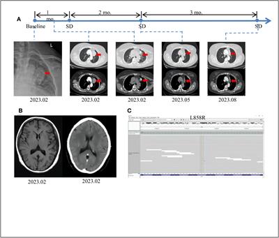 Aumolertinib: effective treatment for asymptomatic pulmonary giant cell carcinoma with EGFR L858R mutation - a case report
